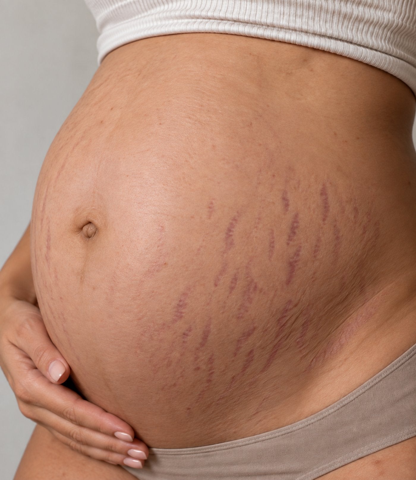 Customer belly at week 0 — visible red stretch marks